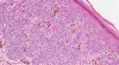 Spitz nevus | MyPathologyReport.ca