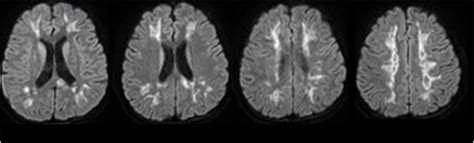 MRI Brain T2-FLAIR (axial) showing white matter hyperintensities in the... | Download Scientific ...