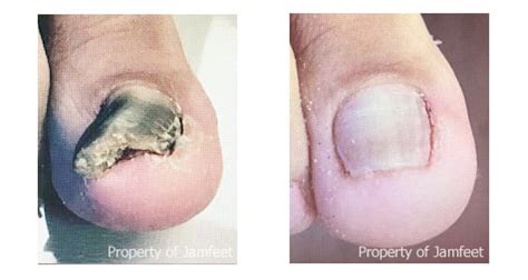 Before and After Toenail Photo | Podiatrist Los Angeles