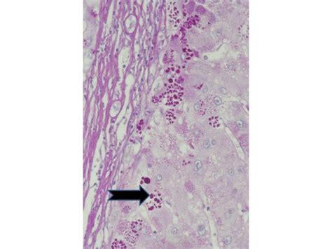 Alpha-1-Antitrypsin Deficiency - Dermatology Advisor