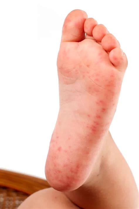 Causes of children's rashes explained - and whether they need to stay off school - Mirror Online