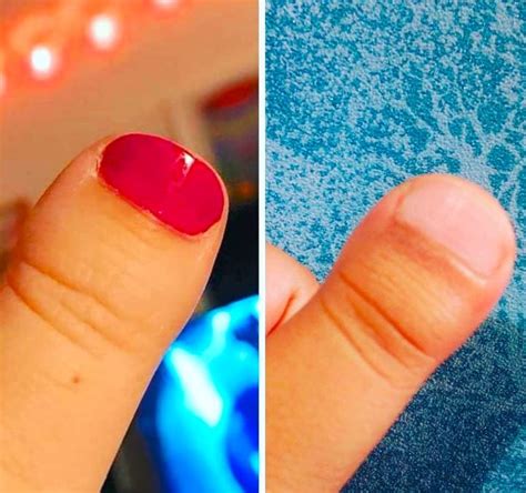 People With Clubbed Thumbs Will Get These 12 Photos