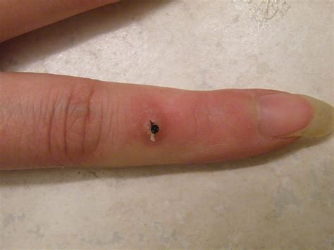 Tales of Mommyhood: Stitches emerging from finger after 7 years