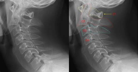 Neck Fracture Treatment | Neck Bone Fracture Surgery