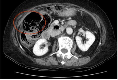 Colon Perforation and Abscess. Axial CT 3. Annotated. JETem 2019 - JETem