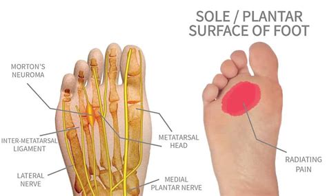 Stump Neuroma - Bregman Foot-Ankle & Nerve Center