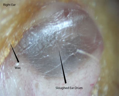 Ear Wax Images | McGovern Medical School