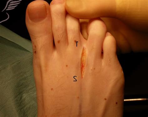 👉 Morton’s Neuroma - Surgery, Symptoms, Pictures, Treatment (February 2022)