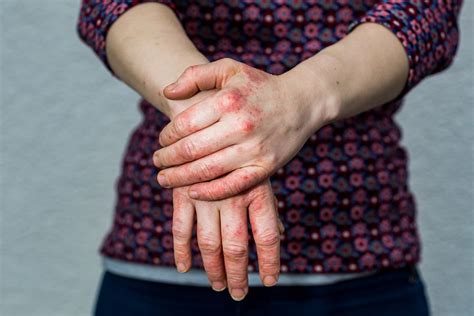 Eczema (Atopic Dermatitis) - Symptoms, Causes, Treatment and Photos