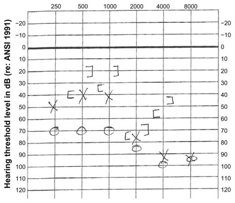 Audiogram of the patient demonstrating bilateral mixed hearing loss. | Download Scientific Diagram