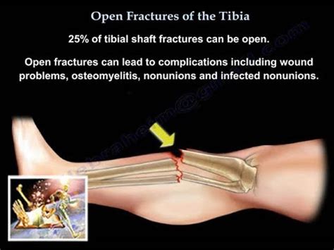 Leg Fracture - Symptoms, Swelling And Treatment Of Open And Closed Leg Fractures. How To Develop ...