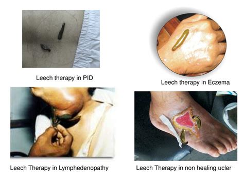 PPT - Leech & Blood Letting Therapy PowerPoint Presentation, free ...