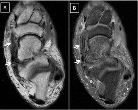 Spring ligament complex: Illustrated normal anatomy and spectrum of ...