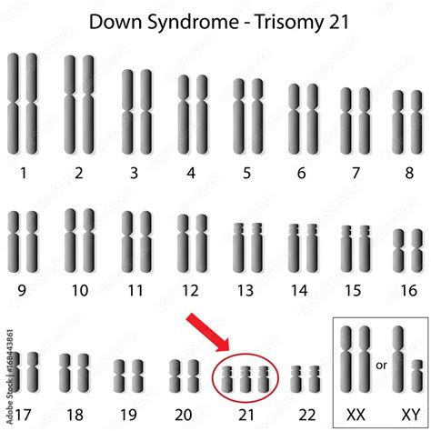 Karyotype of Down syndrome Stock-Illustration | Adobe Stock