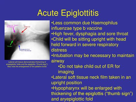 Acute epiglottitis antibiotic treatment