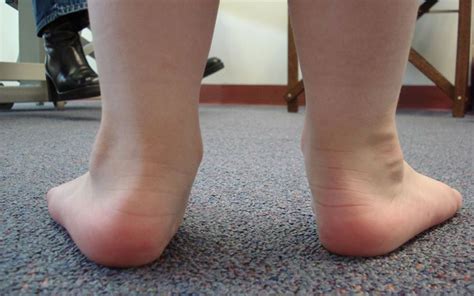 The Most Common Foot Problems in Children - The Blogging Doctors