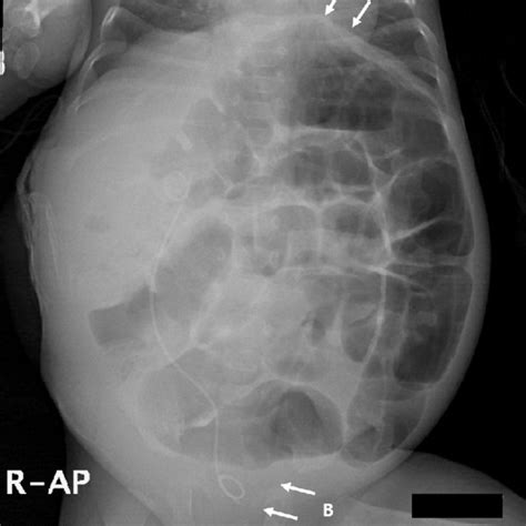 AP abdominal radiograph showing mainly a gas-distended large bowel... | Download Scientific Diagram