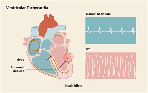 Ventricular Tachycardia Causes Symptoms And Treatments Uchicago ...