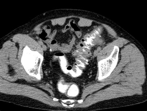 Diverticulitis- CT - Sumer's Radiology Blog