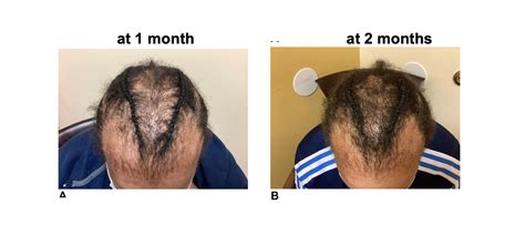 Treatment of Central Centrifugal Cicatricial Alopecia (CCCA) with Baricitinib — Donovan Hair Clinic