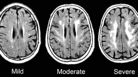 Ketogenic Diets for White Matter Disease | Mental Health Keto