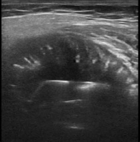 Coronal, axial and sagittal MRI of the lesion. On US examination, an ...