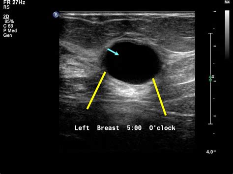 Atlas of breast cancer early detection