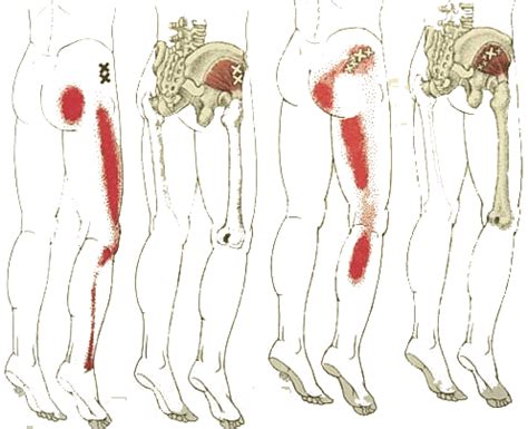 Causas del dolor de cadera y cómo evitar medicamentos para el dolor en ...