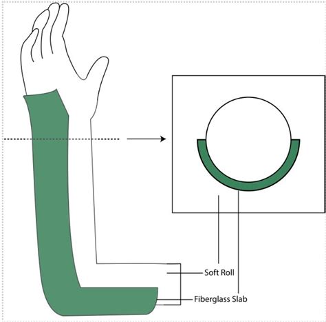 Elbow Fractures : Emergency Care BC