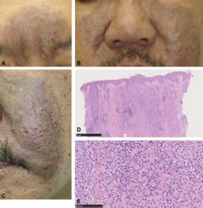 Eosinophilic folliculitis causes, symptoms, diagnosis, treatment ...