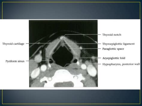 Larynx anatomy ct and mri