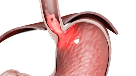 TIF | Transoral Incisionless Fundoplication Comprehensive Guide