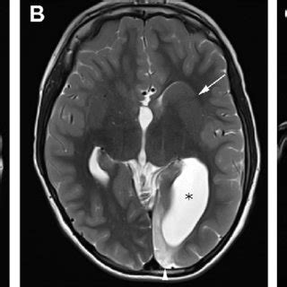 e Axial T2-weighted brain MR imaging showing abnormal configuration of... | Download Scientific ...