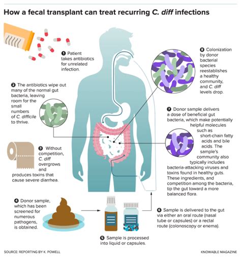 Chart : Infographic: How fecal transplants work against recurrent C. diff infections ...