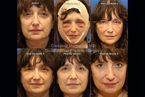 Recovery from Face/Neck Lift New Jersey | Center for Eye & Facial Plastics