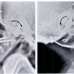 (PDF) Atlanto-axial fusion with transarticular screw fixation