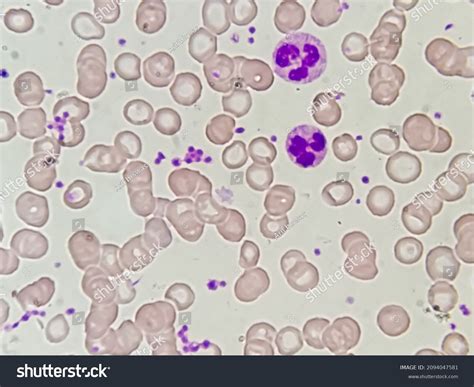 Rare Giant Platelets