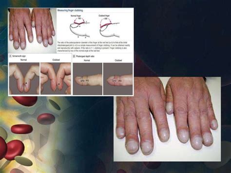 Cianosis Central y Periferica