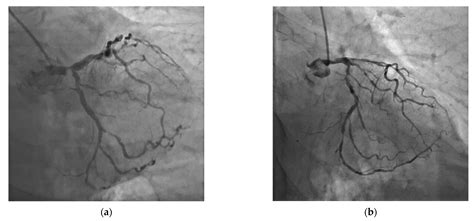 JCM | Free Full-Text | Left Main Coronary Artery Disease—Current Management and Future Perspectives