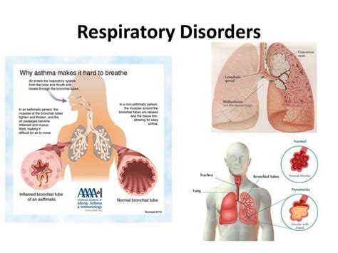 Respiratory Disorders Treatment Market Anticipated to Grow at