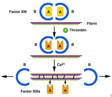 Pathology Outlines - Factor XIII deficiency