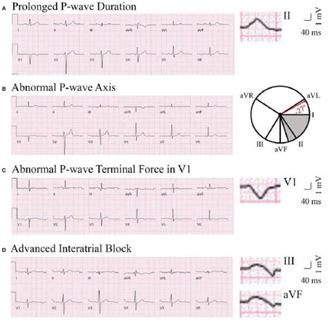 Abnormal Ecg Tracings