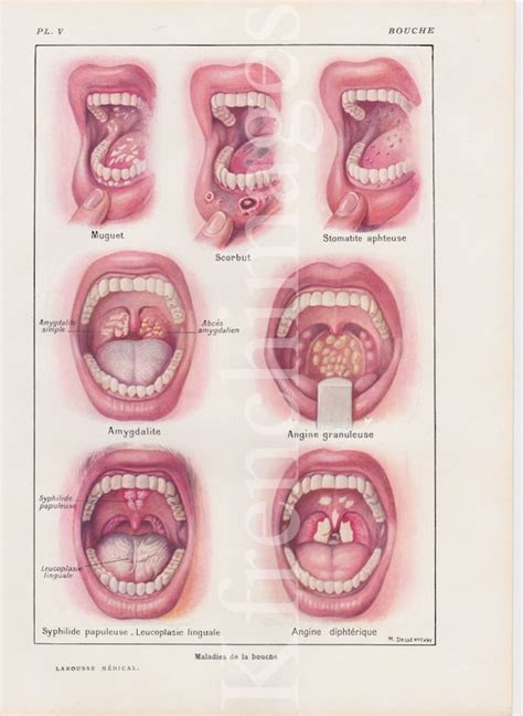 Mouth Diseases Anatomy Plate French Vintage Original Print | Etsy