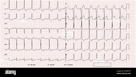 ECG example of a pathological 12-lead rhythm, supraventricular premature beat Stock Photo - Alamy