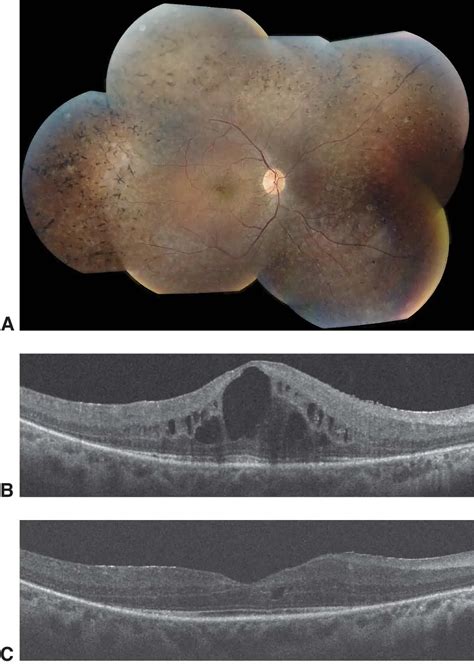 Rod-cone dystrophy - American Academy of Ophthalmology