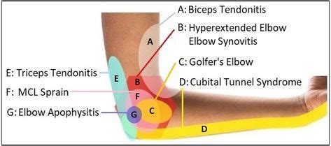 Tendonitis Causes, Tendinitis Elbow, Bursitis, Sore Elbow, Elbow Pain ...