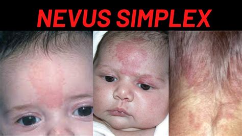 Nevus Simplex Newborn