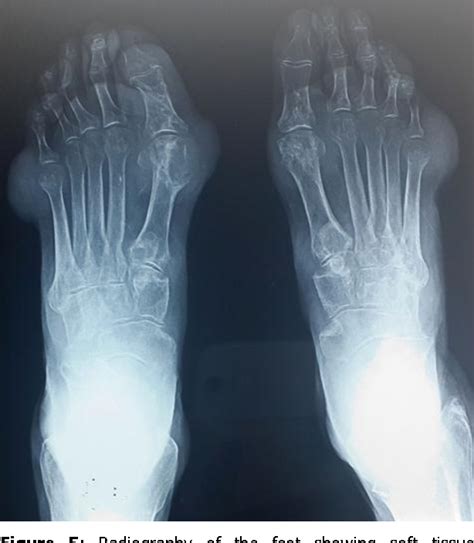 Figure 1 from Chronic tophaceous gout with unusual large tophi: case report | Semantic Scholar