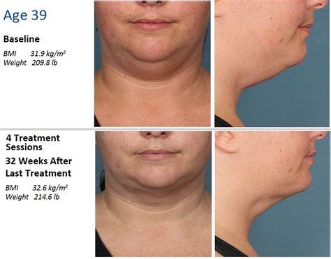 kybella before and after pics - | Kybella, Esthetics, Before and after ...