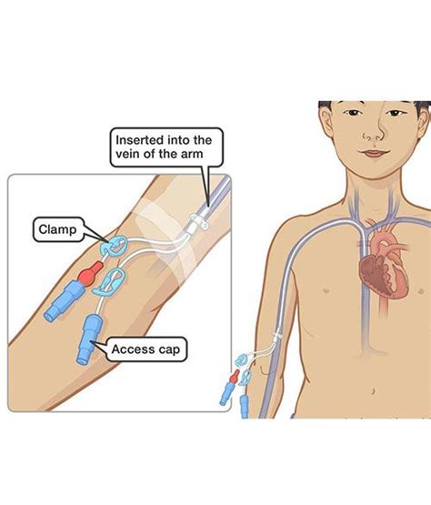 Hickman line, PICC line insertion for Bone – Dr. Kushan Nanavati – Vascular & Endovascular ...